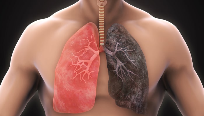 Smoking & COPD: Overview of disease/conditions