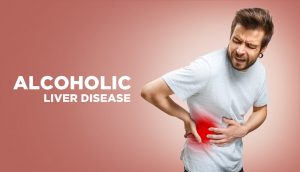 Alcoholic Liver Disease Alcoholic Liver Disease