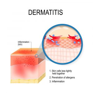 Dermatitis Dermatitis