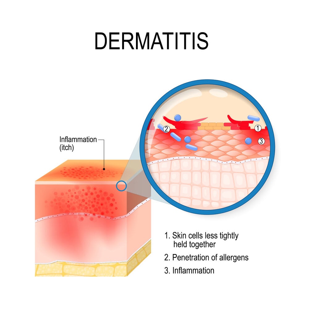 Psoriasis Vs Eczema Let's Understand The Difference