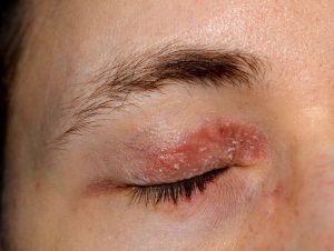Eczema or Psoriasis on eyelids