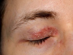 Eczema or Psoriasis on eyelids Eczema or Psoriasis on eyelids