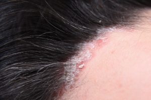 Eczema vs Psoriasis on the scalp