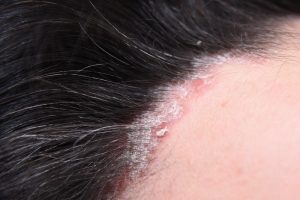 Eczema vs Psoriasis on the scalp Eczema vs Psoriasis on the scalp