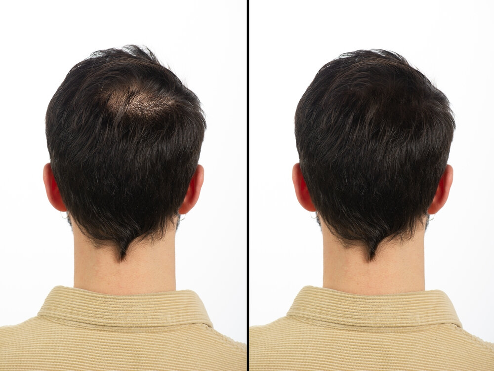 Finasteride vs Propecia Results