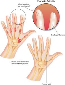 Otezla For Psoriatic Arthritis