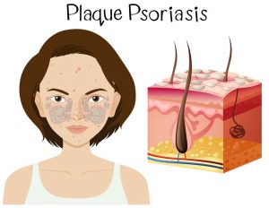 Plaque Psoriasis Plaque Psoriasis