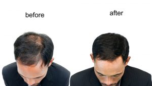 Propecia for Hair Loss