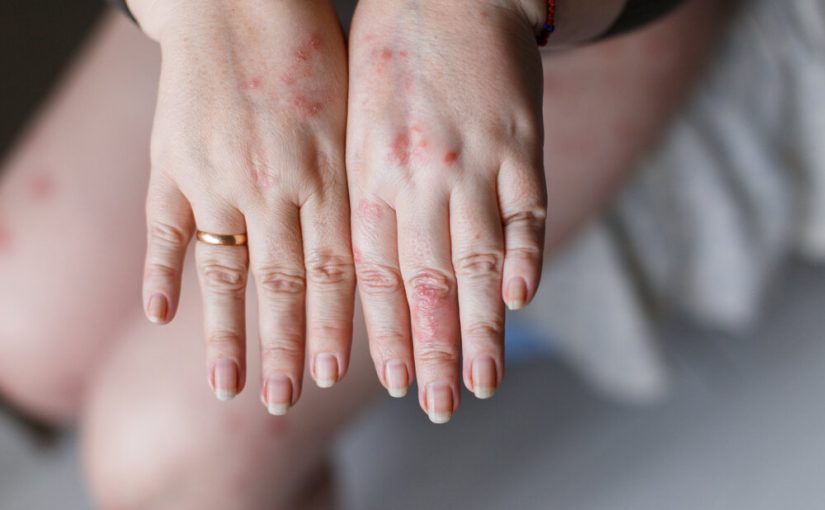 Psoriasis vs Eczema: Let’s Understand The Differences In 15 points