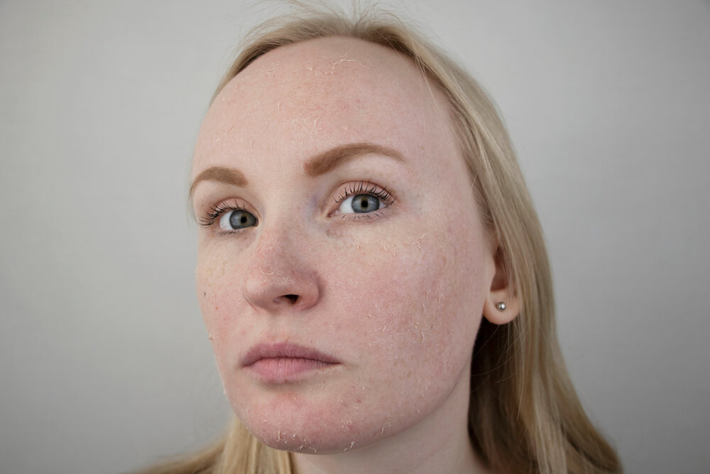 Psoriasis vs Eczema on face