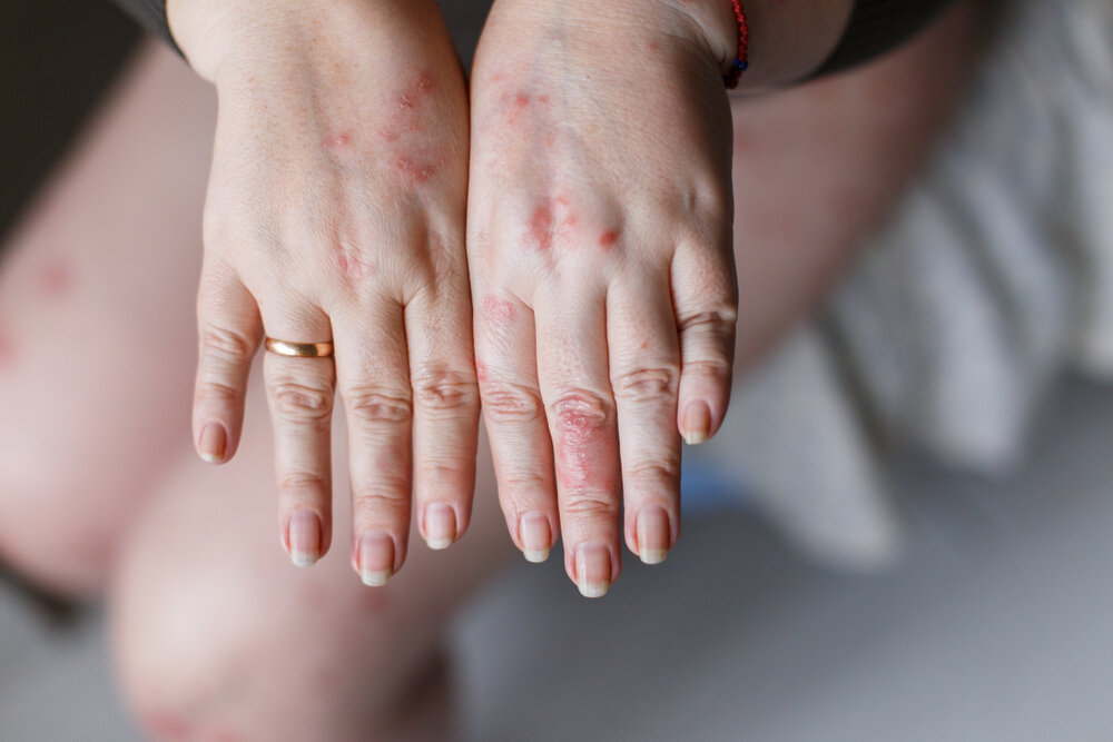 Psoriasis Vs Eczema Let's Understand The Difference