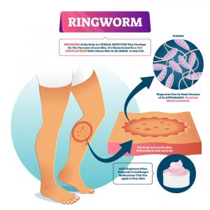 Ringworm