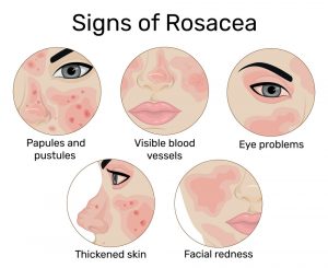 Rosacea Rosacea