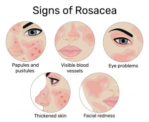 Rosacea