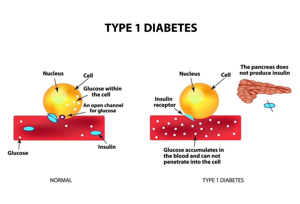 Type 1 Diabetes