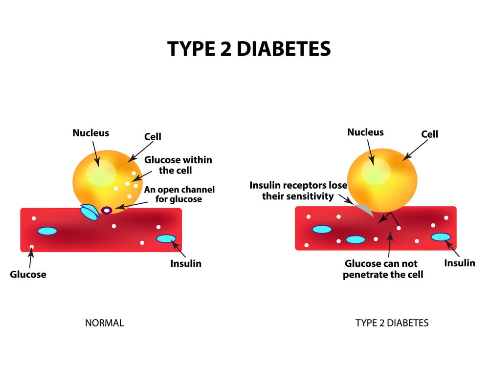 Type 2 Diabetes