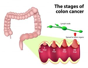 Stages Of Colon Cancer