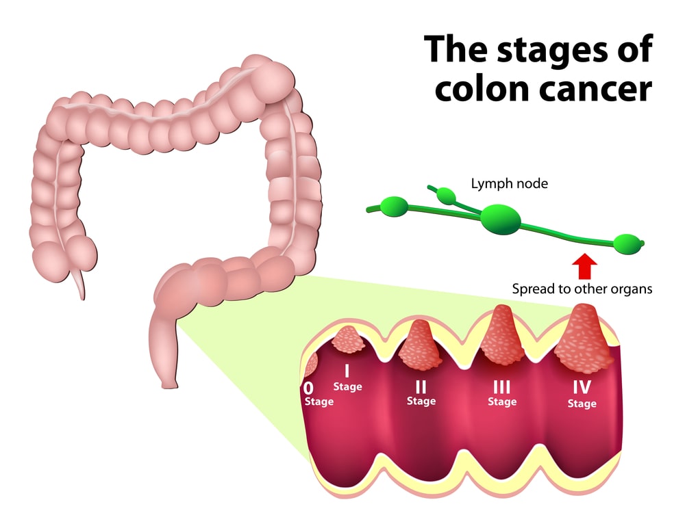 Vegetarian Diet and Colon Cancer Does it lower your risk