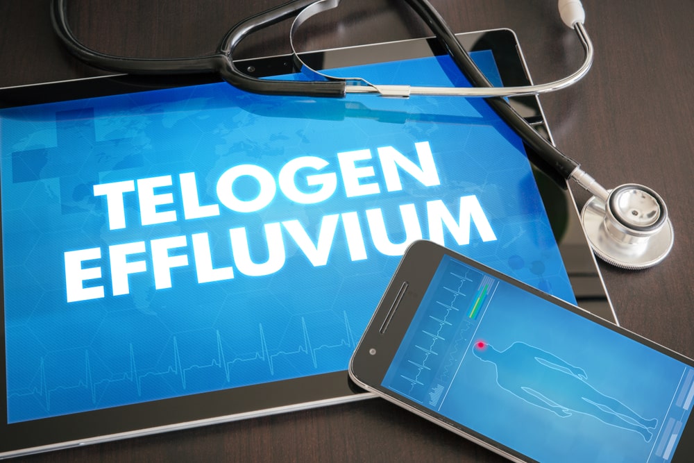 HIV And Telogen Effluvium HIV And Telogen Effluvium