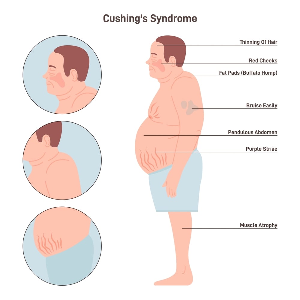 Symptoms of Cushing Syndrome