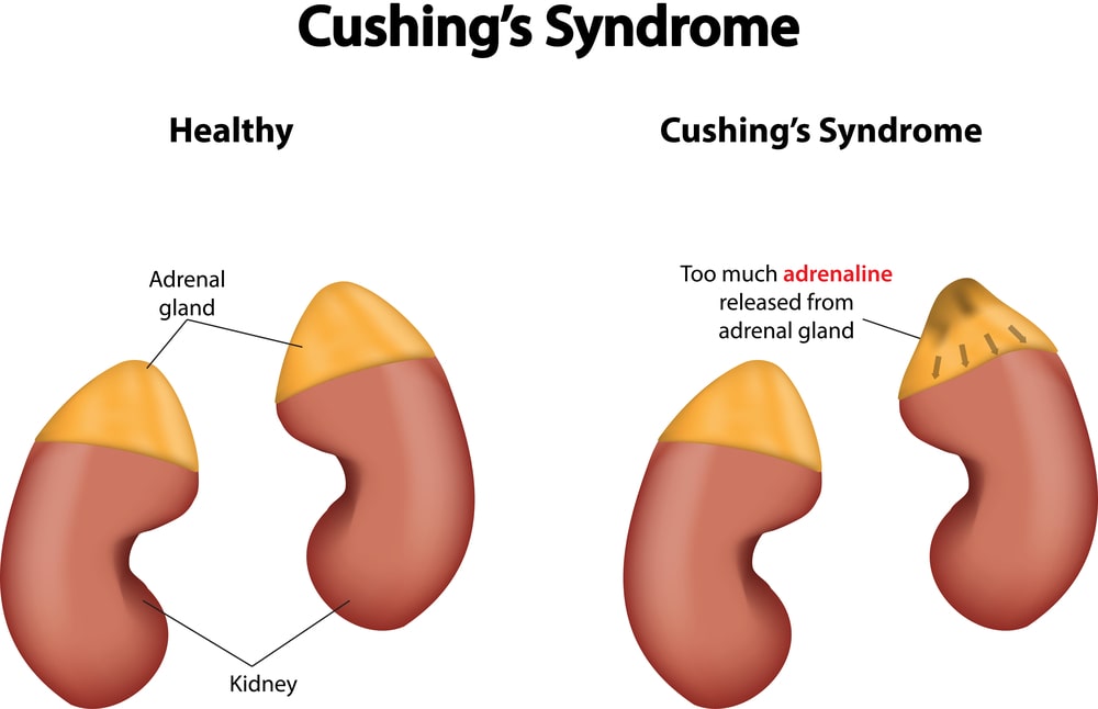 What is Cushing's Syndrome?