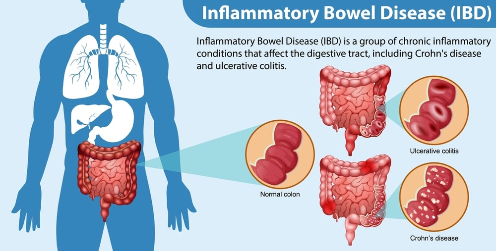 Inflammatory Bowel Disease