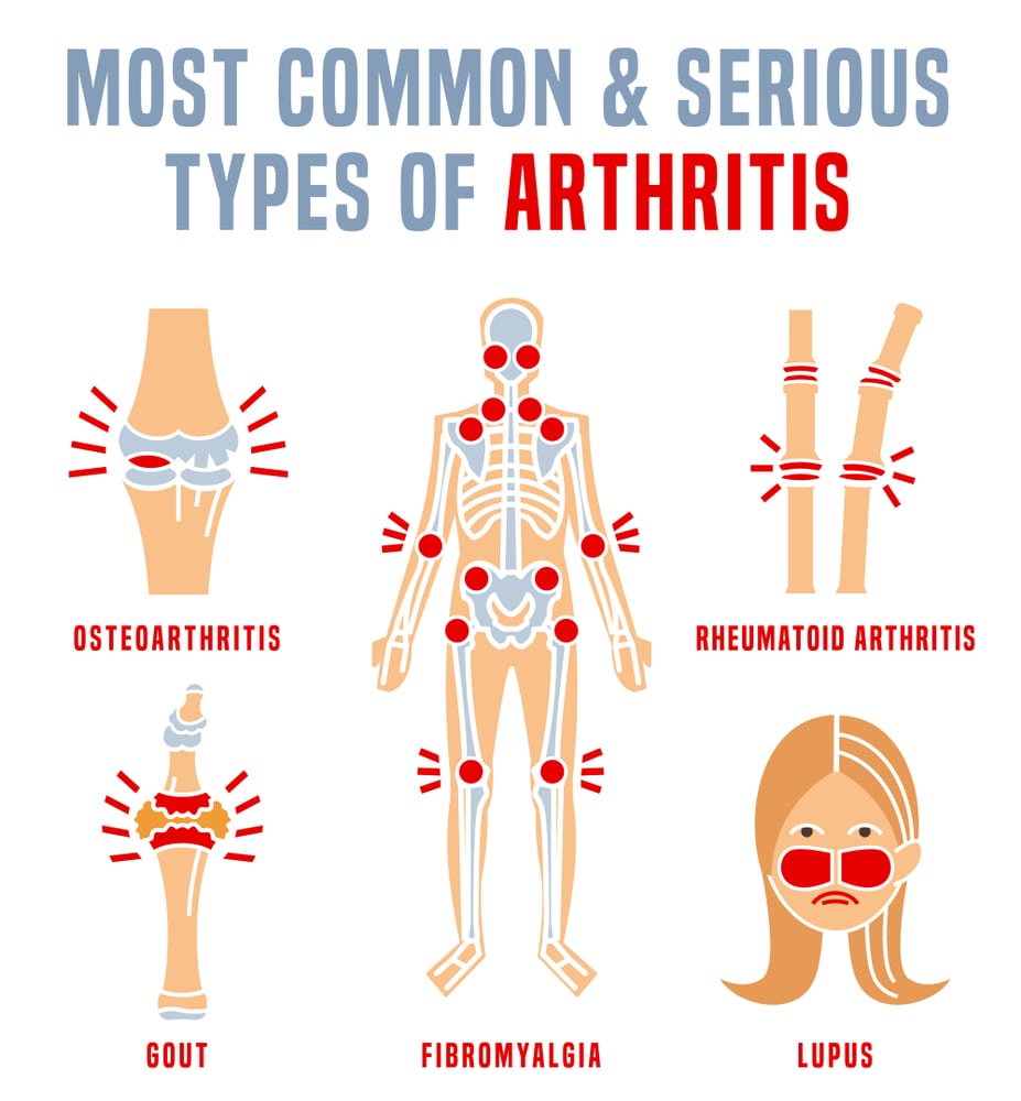 Different Types of Arthritis
